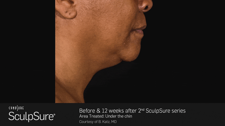 Before and after 12 weeks after 2nd SculpSure series - female, side view - patient 1