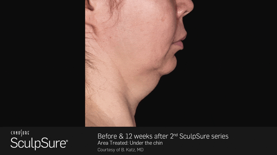 Before and after 12 weeks after 2nd SculpSure series - female, side view - patient 2