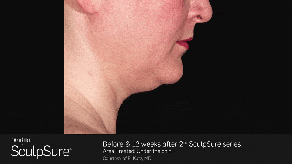 Before and after 12 weeks after 2nd SculpSure series - female, side view - patient 3