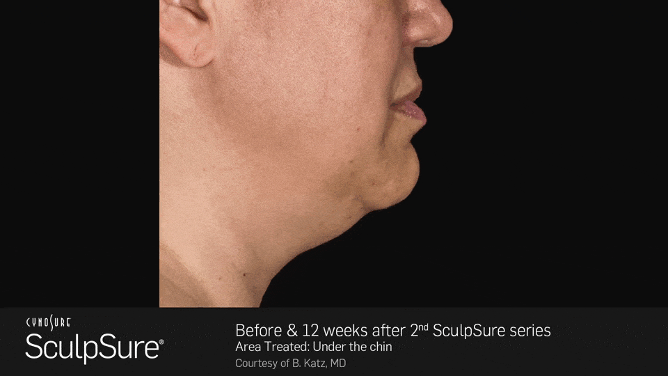 Before and after 12 weeks after 2nd SculpSure series - female, side view - patient 1