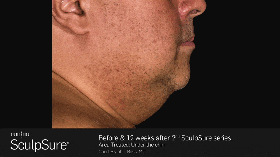 Before and after 12 weeks after 2nd SculpSure series - male, side view - patient 1