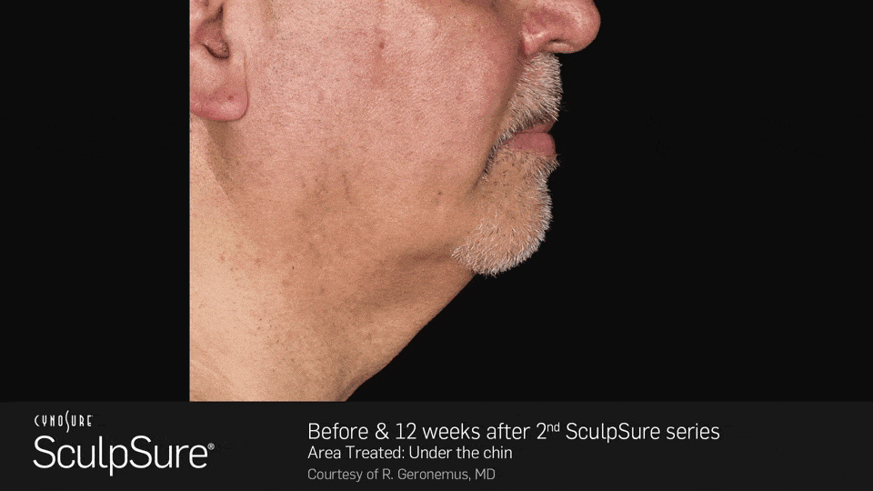 Before and after 12 weeks after 2nd SculpSure series - male, side view - patient 2