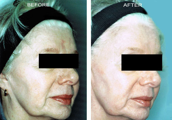 Fractional Erbium Yag Laser Mini Peel - Photo 49