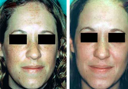 MELASMA BEFORE & AFTER PHOTOS