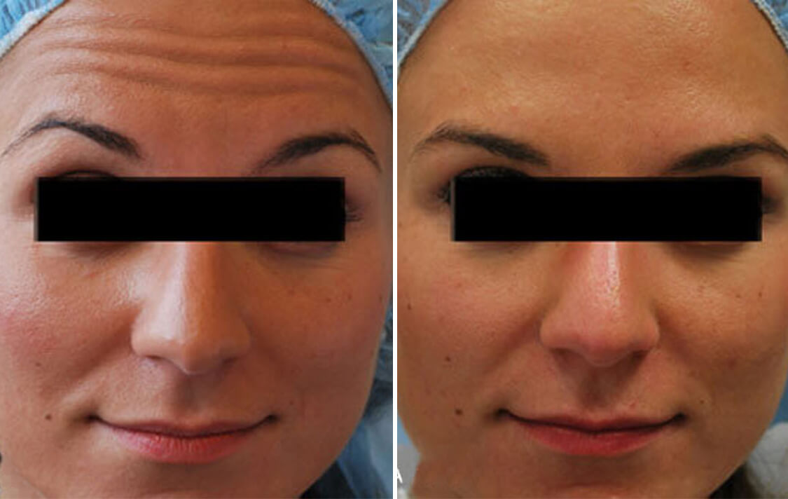 How Often Should I Get a Botox Touch-Up?