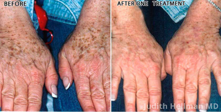 brown-spot-removal-nyc-remove-brown-spots-new-york