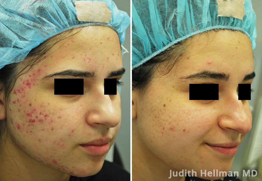 bacne scars before and after