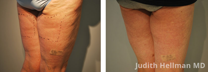 Before & After Photos Cellulite Reduction