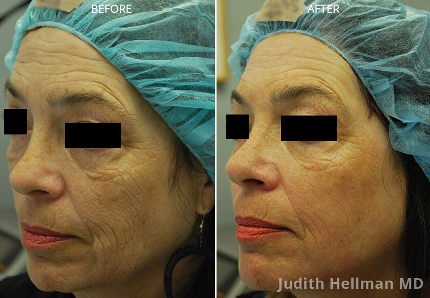 Pre and post procedure photographs of fractional CO2 laser withprp patients